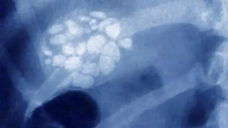 Mennyi az epehólyag súlya?' title='Mennyi az epehólyag súlya?